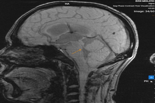 Kỹ thuật cộng hưởng từ tương phản pha (PC-MRI) trong đánh giá động học dòng chảy dịch não tủy